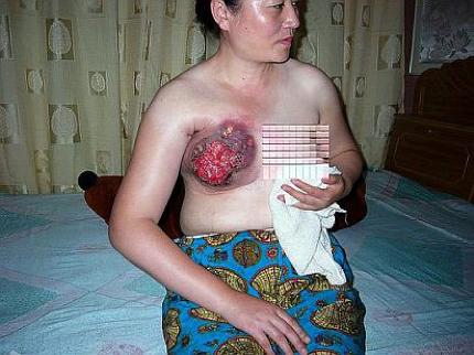 ◆中国では女性の乳房を高電圧で壊死させるような拷問をする